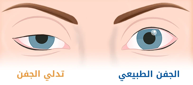 ماذا يعني تدلي الجفون  في الهند؟